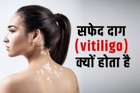 Vitiligo